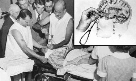 Lobotomija: Zastrašujući tretman nagrađen Nobelovom nagradom